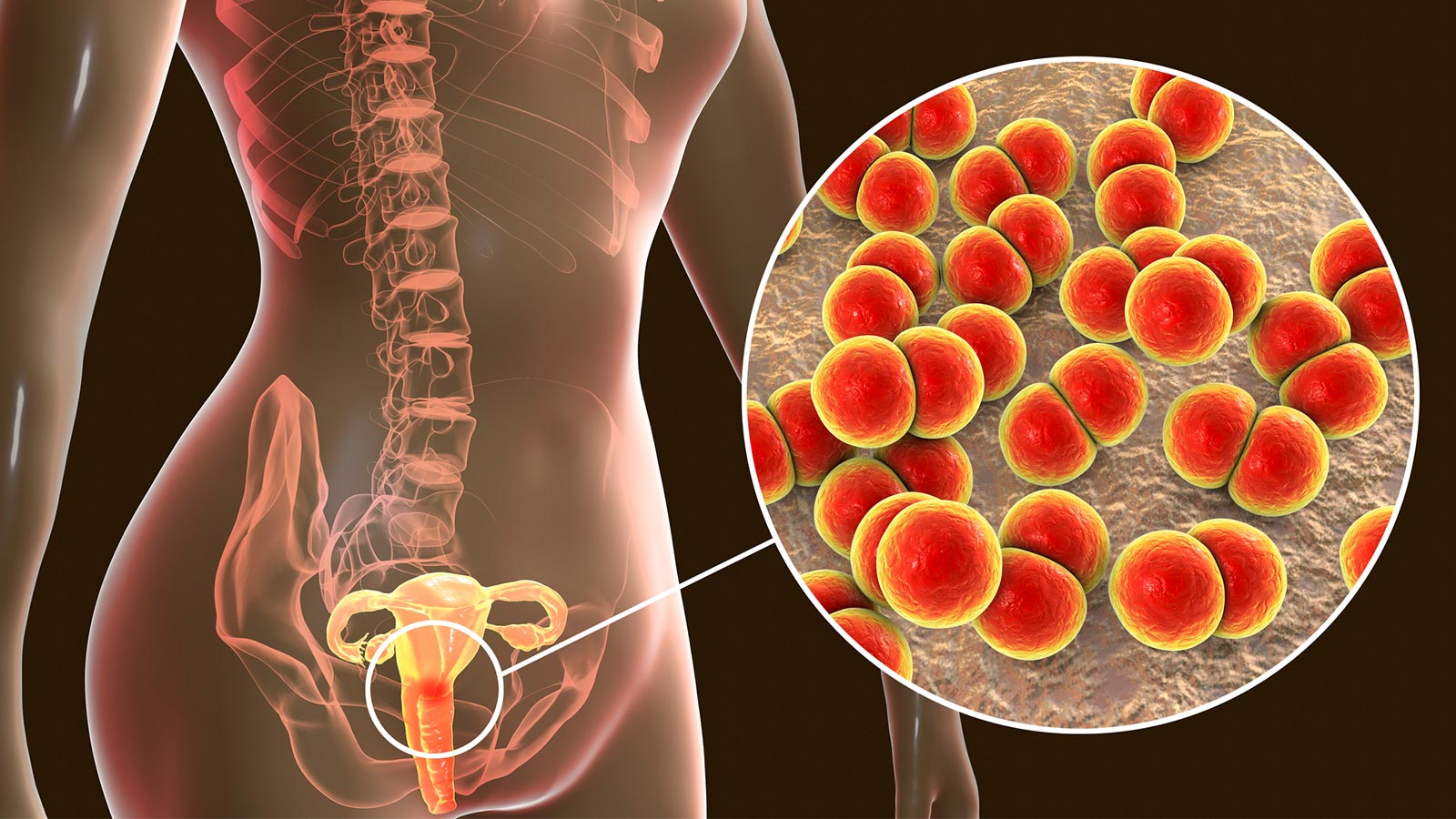 enfermedad infecciosa de transmisión sexual